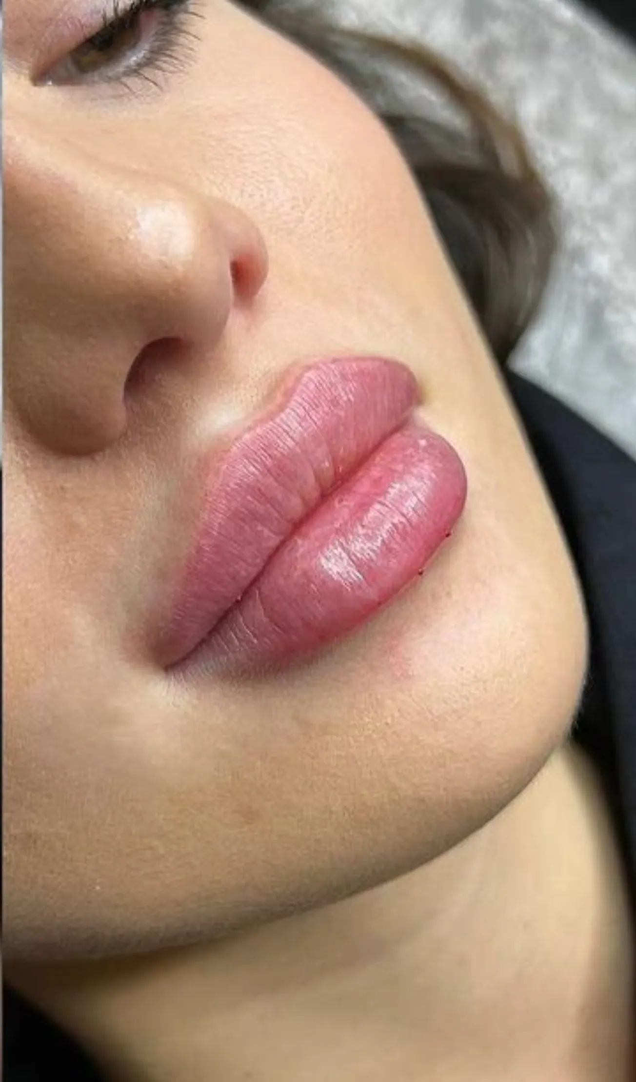 Lips, after treatment