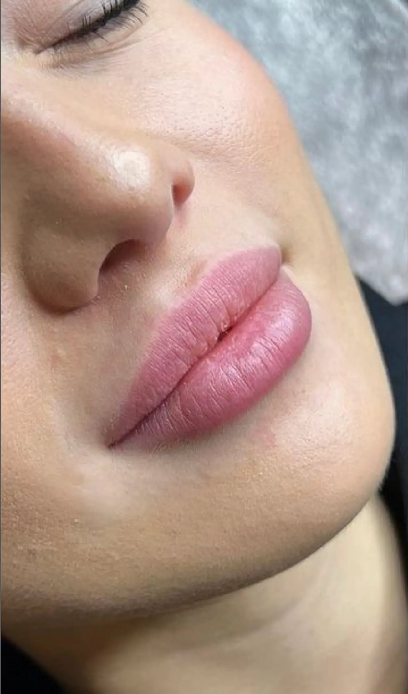 Lips, before treatment